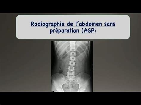 radiographique de l abdomen sans préparation YouTube