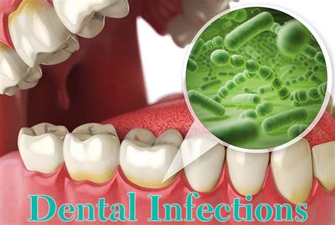 Tooth Infections - Emergency Treatment Available - Carson & Carson, DDS