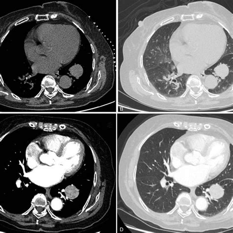 Chest X Ray A Showed Left Lower Lobe Lung Nodule Ct Scan B Sexiezpix