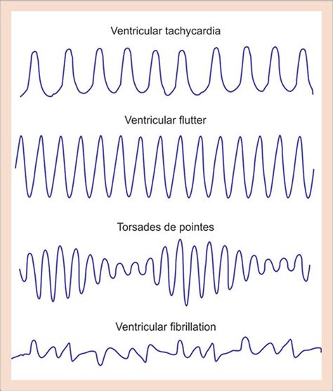 Ventricular Flutter