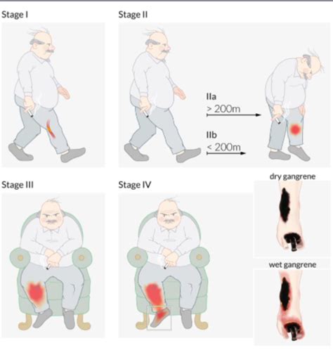 Leg Pain And Ulcers Vascular Week Flashcards Quizlet