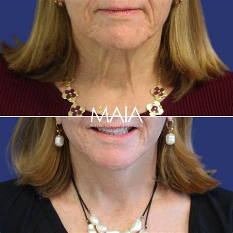 Washington Dc Neck Lift Surgery Before And After Pictures Tysons Corner