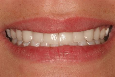 Birmingham Dentist Smile Gallery Cosmetic Dentistry