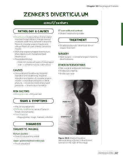 Zenker diverticulum | Osmosis