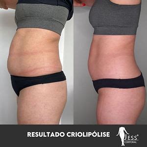 Criolipólise em Porto Alegre Clínica Especializada veja os