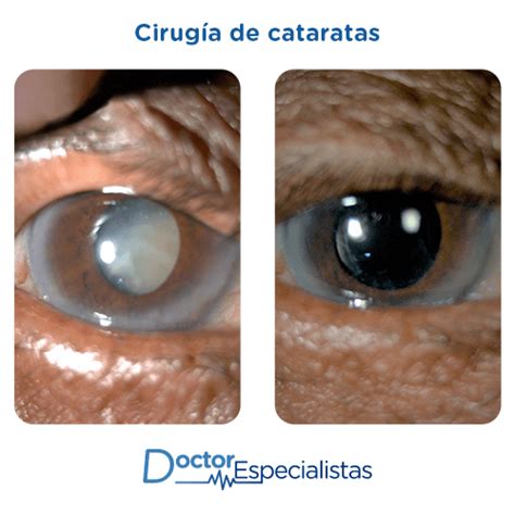 Mejores Oftalmologos Para Cirugia De Cataratas Doctor Especialistas