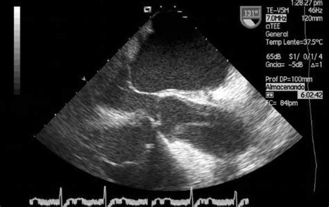 Transesophageal Echocardiography Long Axis View Showing The Download Scientific Diagram