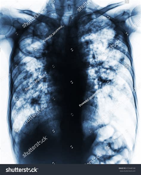 Pulmonary Tuberculosis Film Chest Xray Show Foto De Stock