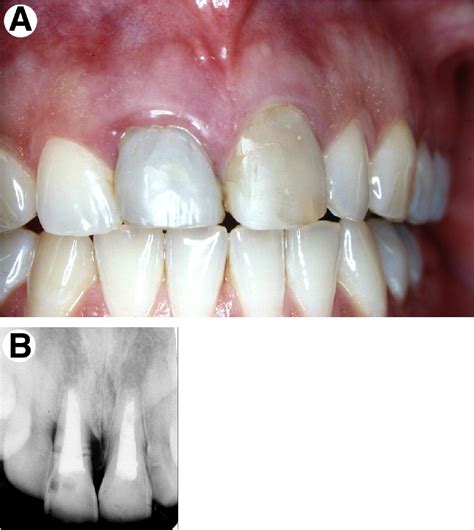 Immediate Placement of Dental Implants Into Debrided Infected