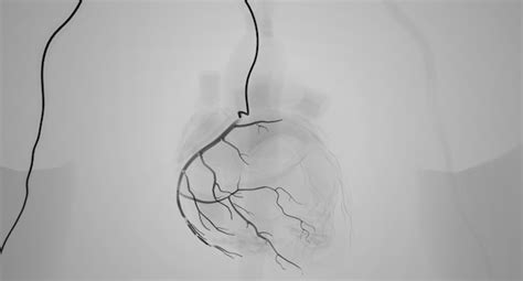 Premium Photo | Catheter as tool for coronary angiography