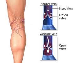 Treatment For Bleeding Varicose Veins