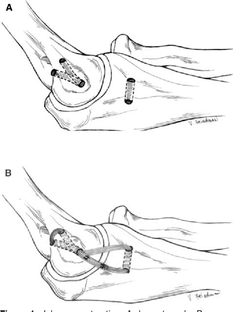 Figure From Biomechanical Evaluation Of Techniques For Ulnar