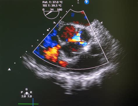 Ecocardiografía De Doppler Imagen De Archivo Imagen De Segmento 52734865