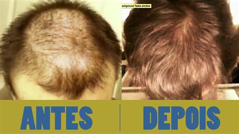 Antes E Depois Minoxidil Kirkland Calvicie 8 Meses YouTube