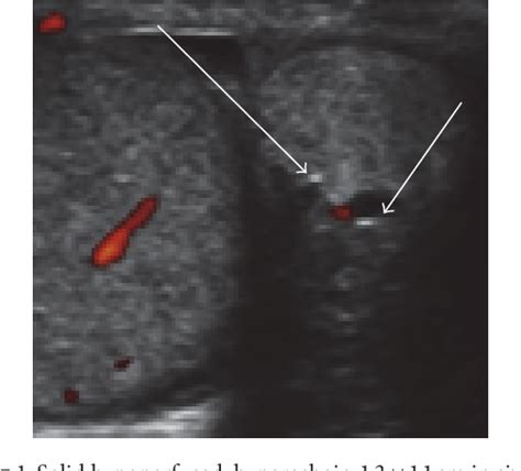 Epididymal Adenomatoid Tumor Semantic Scholar