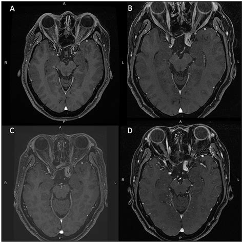 Frontiers Case Report Ruptured Internal Carotid Artery Fusiform