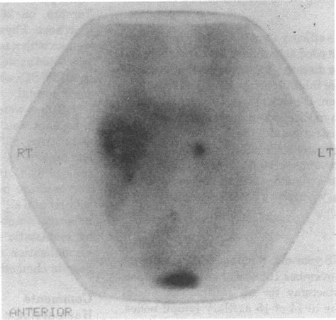 Methyl Iodobenzylguanidine Scan Showing Isotope Uptake By The Liver And