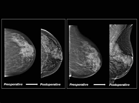 Figure 4 From Reduction Mammoplasty What Radiologists Should Know