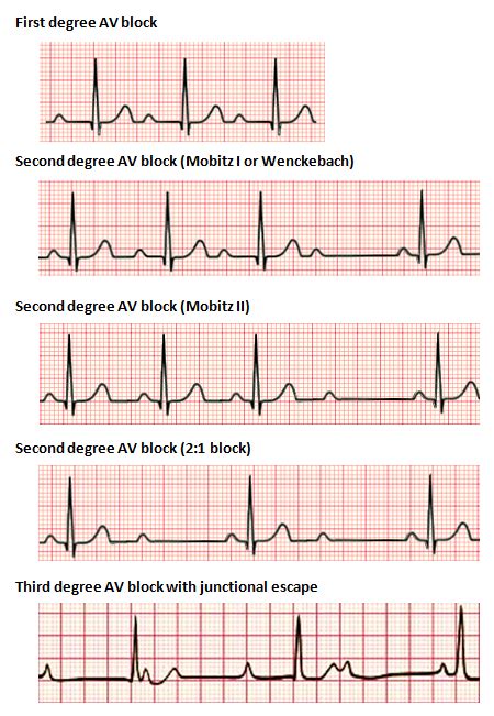 How Do You Read Cardiac Rhythm Strips - Robert Reese's Reading Worksheets