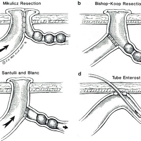 Intraoperative Image Of Pyloromyotomy For Idiopathic Hypertropic