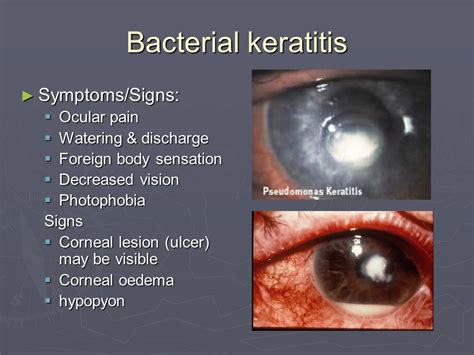 Bacterial Keratitis Symptoms