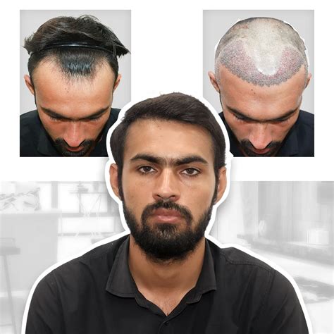 An Overview On Hair Transplant Cost Get Lowest Hair Transplant Cost