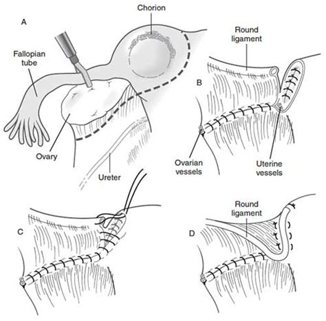 Ectopic Pregnancy—laparotomy Case File