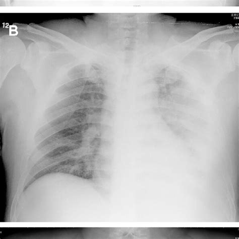 A Chest Plain Film In May 2006 Shows Haziness In The Left Lower Lung