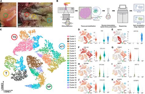 Spatial Transcriptomics Clustering And Marker Genes Of Four Pancreatic