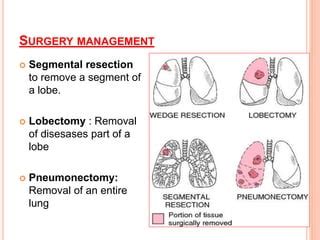 Bronchiectasis Nursing Management Ppt