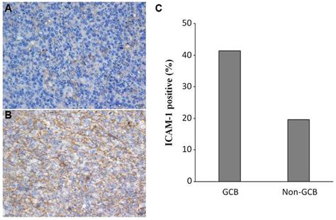 ICAM 1 Expression In DLBCL Patients Representative Immunohistochemical