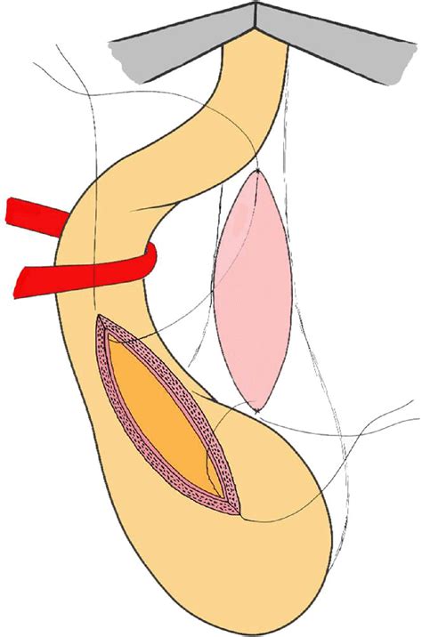 Bulbar Urethroplasty With Dorsal Onlay Buccal Mucosal Graft And Fibrin