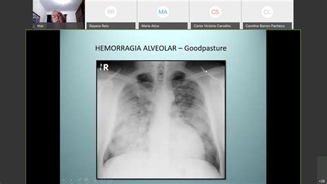 I Minicurso De Radiologia De Tórax 4ª Aula Youtube