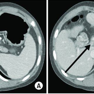 Preoperative Computed Tomography Scan Showing A Cavernous Formation