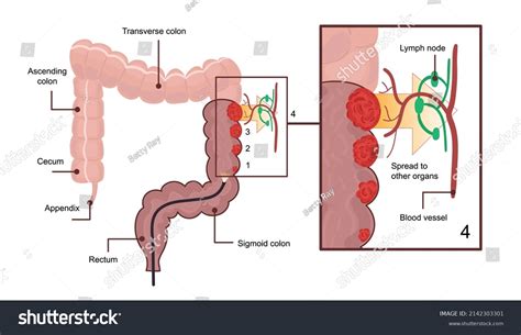 Medical Diagram Colon Cancer Scheme Anatomical Stock Vector (Royalty ...