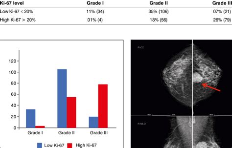 Ki 67 Expression And Tumour Grade In 300 Cases Of Breast Cancer