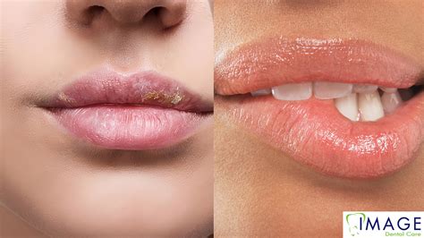 Lips Cancer Symptoms In Hindi At Azzie Molina Blog