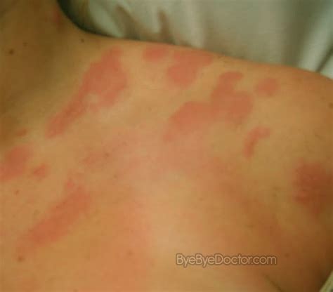 Shingles – Symptoms, Causes, Treatment, Contagious, Pictures ...