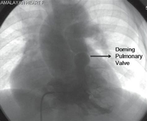 Estenosis Pulmonar Concise Medical Knowledge