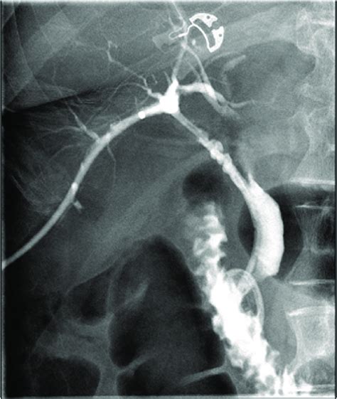 ERCP Rendezvous Allowing The Placement Of The Percutaneous Drain