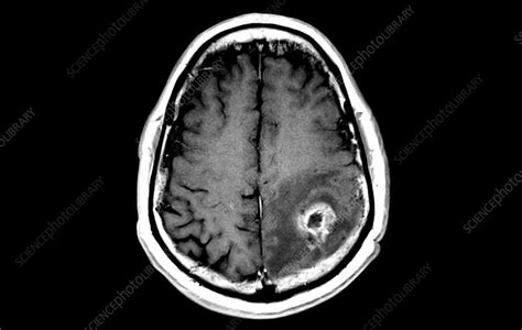 Brain cancer, axial MRI scan - Stock Image - C047/6339 - Science Photo Library