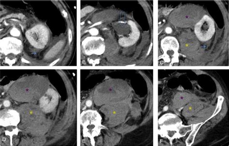 Year Old Woman With A Retroperitoneal Warfarin Induced Hematoma