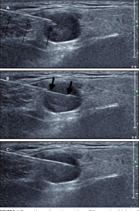 Figure From The Role Of Core Needle Biopsy In The Evaluation Of Head