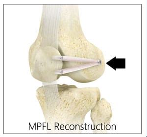 The Dislocated Patella or Kneecap: It Is More Common Than You Think