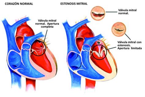 Estenosis Mitral Diagnostico Medico