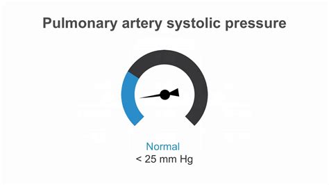 How To Estimate Pulmonary Artery Systolic Pressure PASP Using Echo