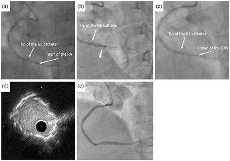 Use Of The Orbital Atherectomy System Backed Up With The Guide