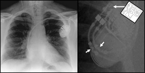 Mri Surescan Pacemaker Patient Manual