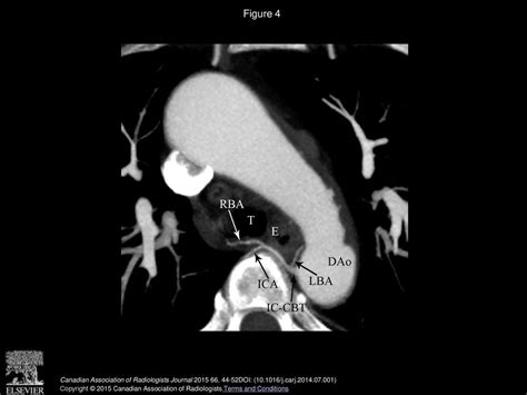 The Normal Anatomy And Variations Of The Bronchial Arteries Evaluation