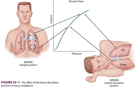 Anesthesia for Thoracic Surgery: The Lateral Decubitus Position